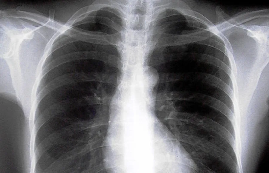 "IV Jornadas Fueguinas de Diagnóstico en Patología Pulmonar 