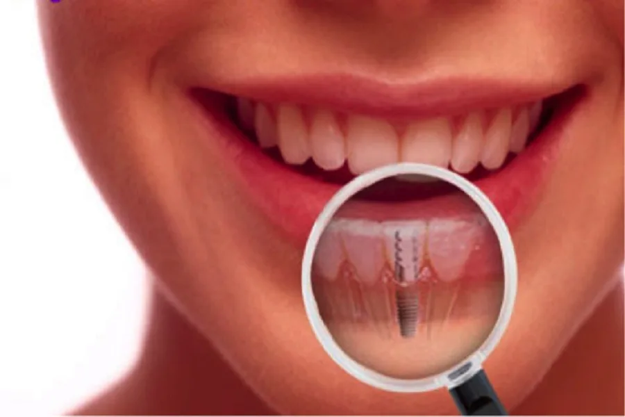 Obras Sociales deberían cubrir la totalidad de los implantes dentales