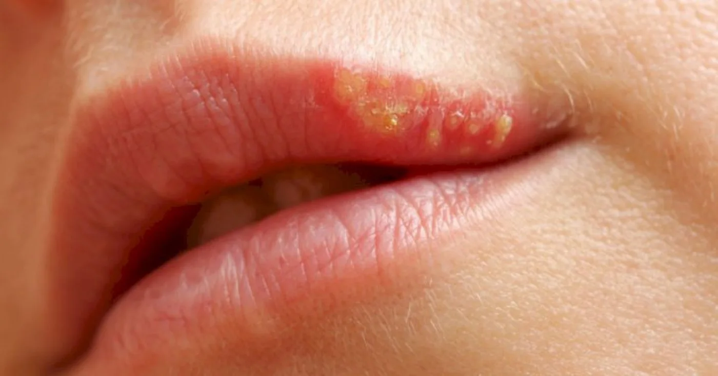 La culebrilla se refiere al herpes zóster, o reactivación del virus varicella zoster.