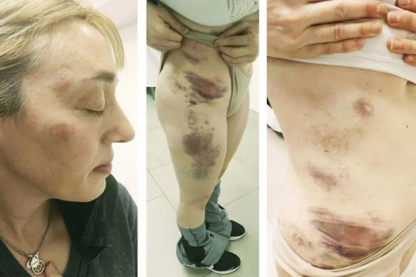 La mujer del funcionario del STJ mostró marcas de golpes en todo su cuerpo. Aseguró que fueron por los golpes de su marido.