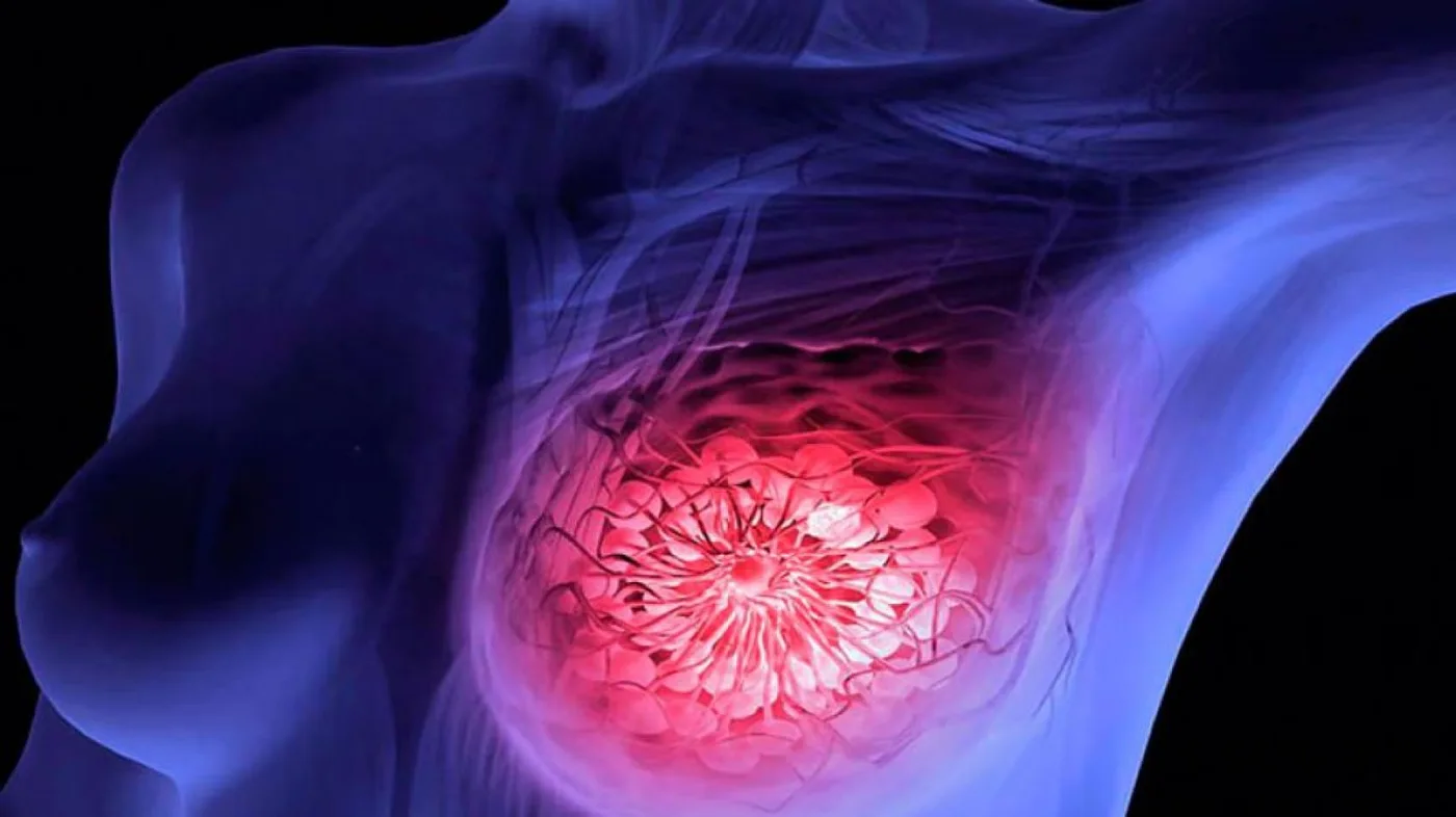 Identifican molécula que vincularía el síndrome metabólico con el cáncer de mama agresivo.