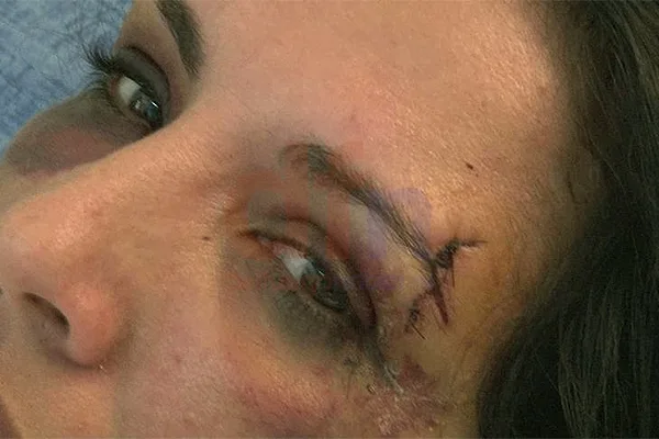 Mónica Ojeda sufrió severas lesiones tras ser atropellada.
